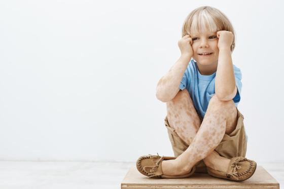 vitiligo.jpg